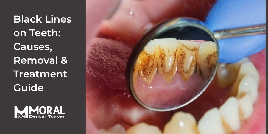 Black Lines on Teeth: Causes and Treatment