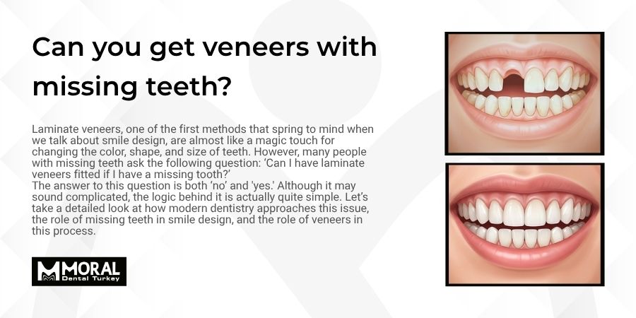 Can You Get Veneers With Missing Teeth?