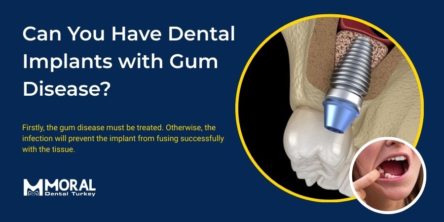 Can You Have Dental Implants with Gum Disease?