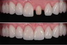 Why does the tooth under the crown appear black/dark?