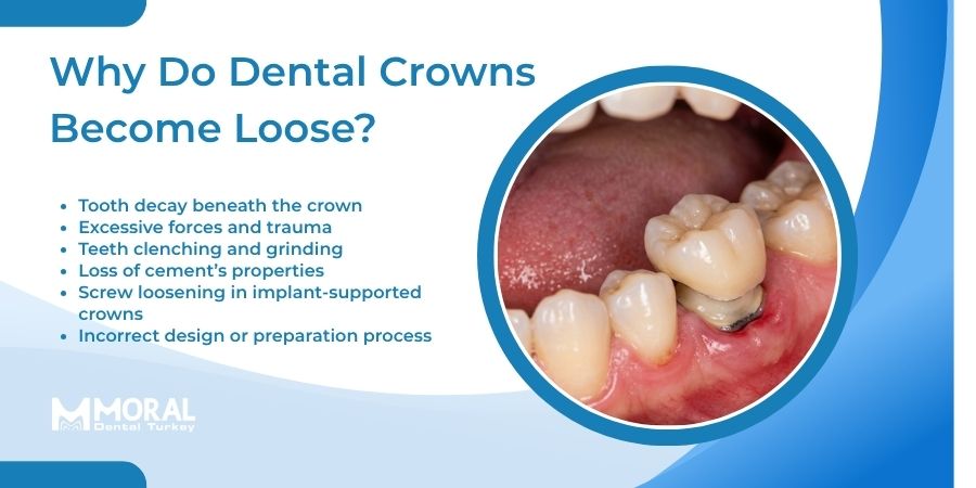 Tips to Deal With a Loose Dental Crown